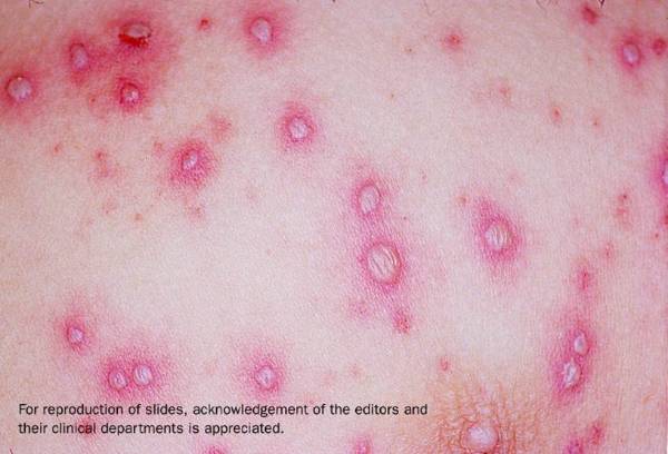 水痘的皮肤表面